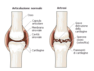 Artrosi