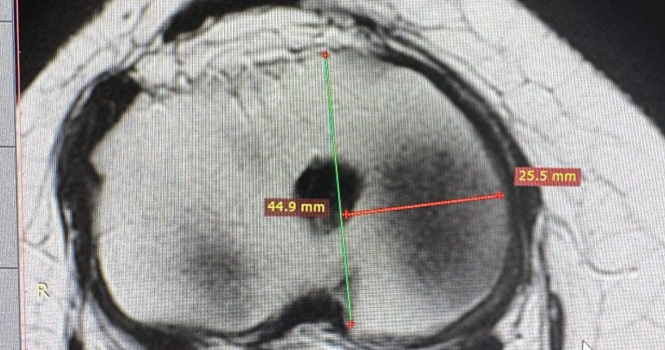 Misurazione e pianificazione per intervento menisco (2)