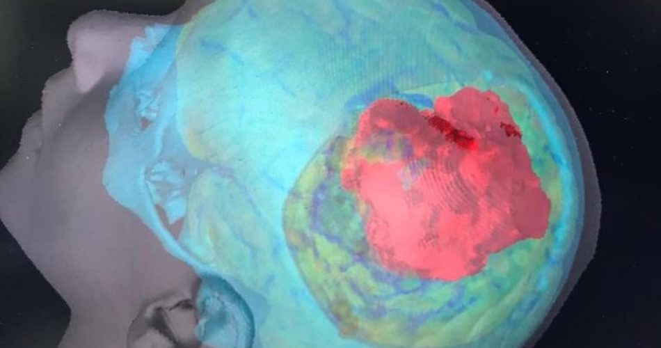 Sarcoma_neuroimagin3d