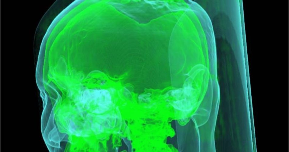 Tac con estensione del tumore esterna al cranio