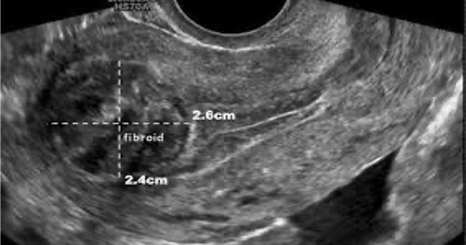 Vista ecografica fibroma