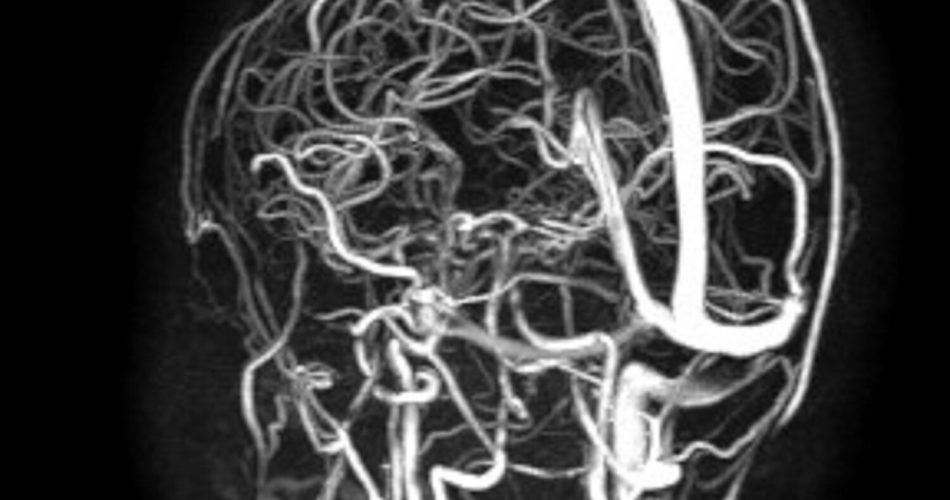 angioRM pre - trombosi asse trasverso-sigmoide.giugulare dx
