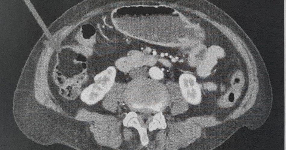 chirurgia corato - tc addome che evidenzia la massa tumorale