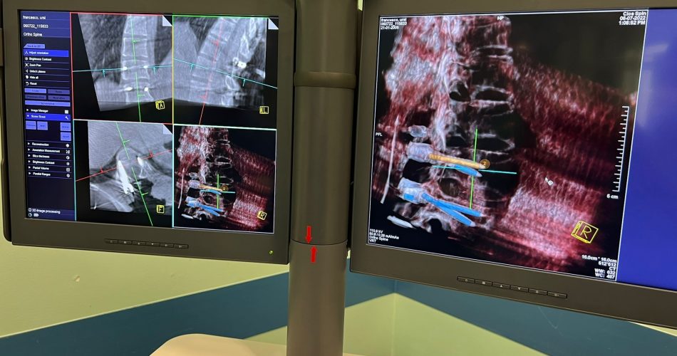 computer assisted spine surgery (2)
