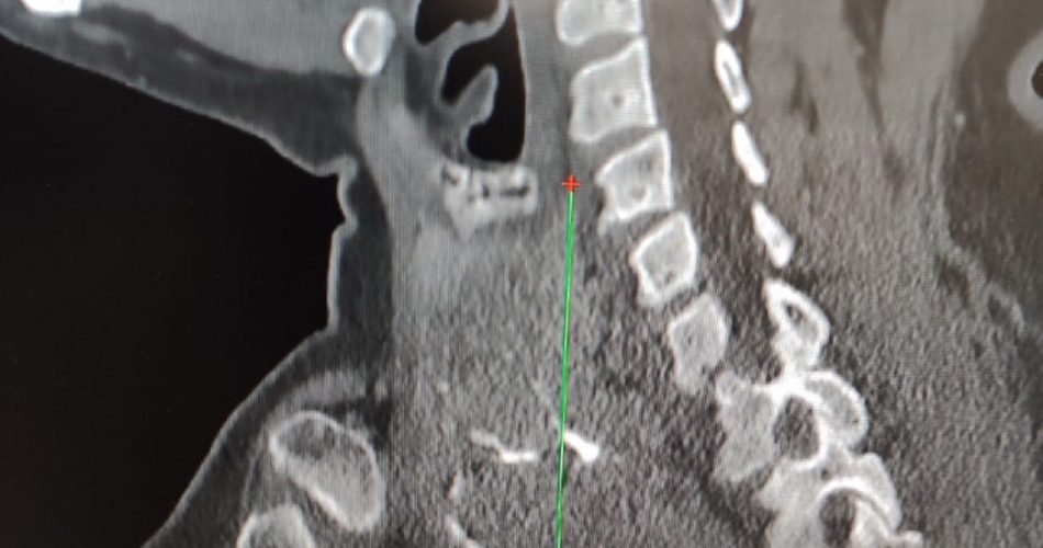 estensione gozzo tiroideo