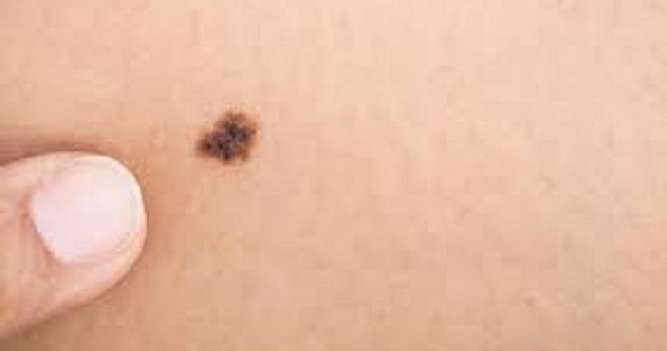 melanoma